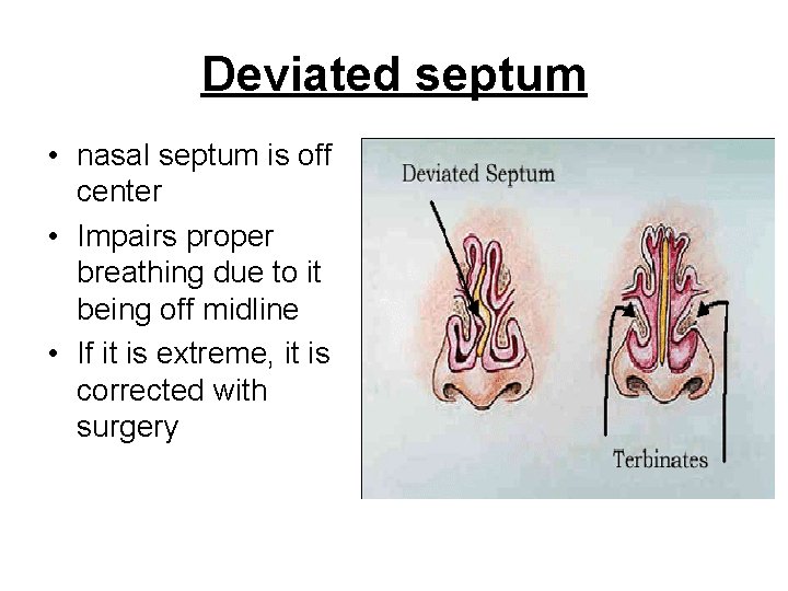 Deviated septum • nasal septum is off center • Impairs proper breathing due to