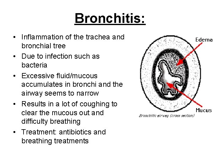 Bronchitis: • Inflammation of the trachea and bronchial tree • Due to infection such