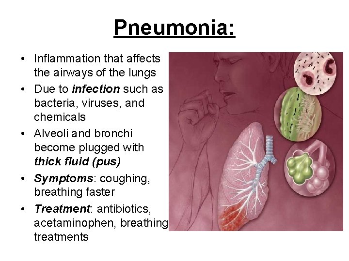 Pneumonia: • Inflammation that affects the airways of the lungs • Due to infection