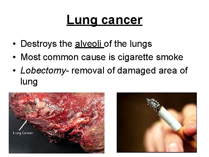 Lung cancer • Destroys the alveoli of the lungs • Most common cause is