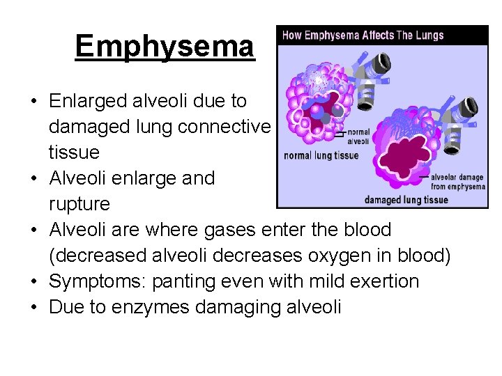 Emphysema • Enlarged alveoli due to damaged lung connective tissue • Alveoli enlarge and