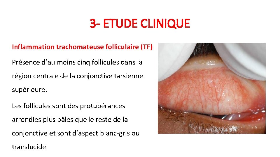3 - ETUDE CLINIQUE Inflammation trachomateuse folliculaire (TF) Présence d’au moins cinq follicules dans