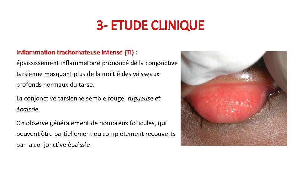 3 - ETUDE CLINIQUE Inflammation trachomateuse intense (TI) : épaississement inflammatoire prononcé de la