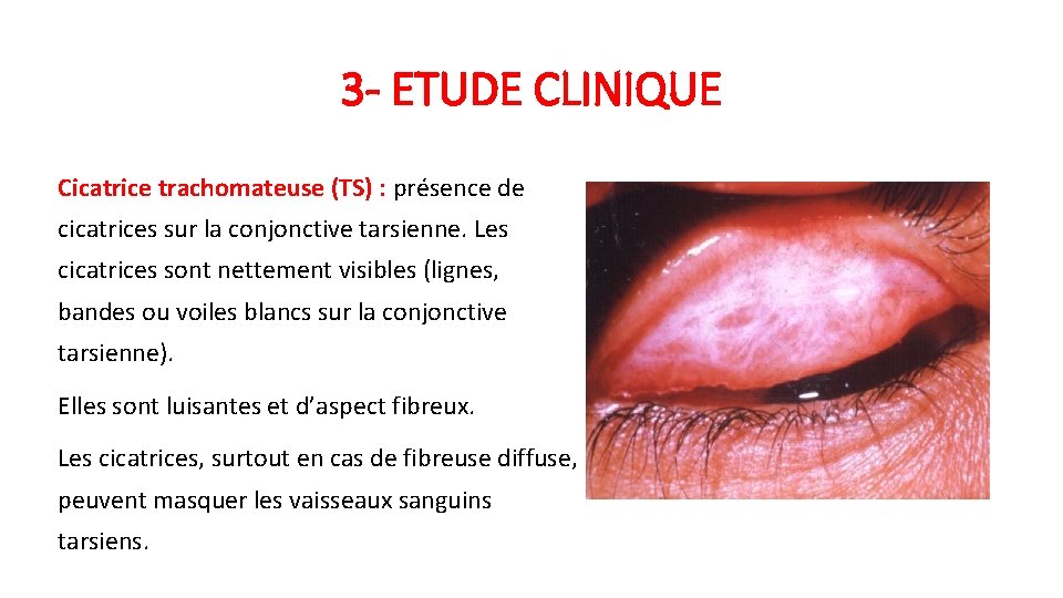 3 - ETUDE CLINIQUE Cicatrice trachomateuse (TS) : présence de cicatrices sur la conjonctive