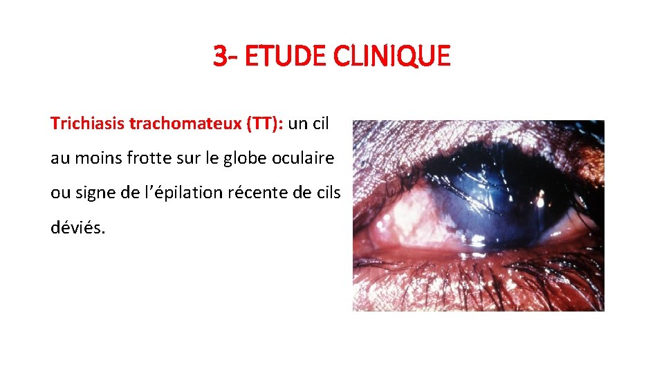 3 - ETUDE CLINIQUE Trichiasis trachomateux (TT): un cil au moins frotte sur le 3 - ETUDE CLINIQUE Trichiasis trachomateux (TT): un cil au moins frotte sur le