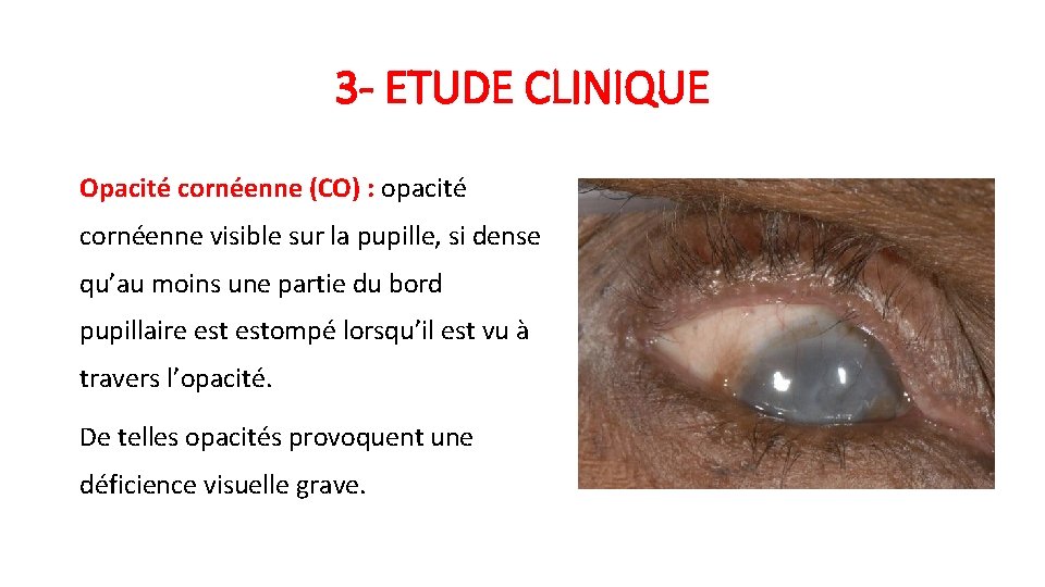 3 - ETUDE CLINIQUE Opacité cornéenne (CO) : opacité cornéenne visible sur la pupille,