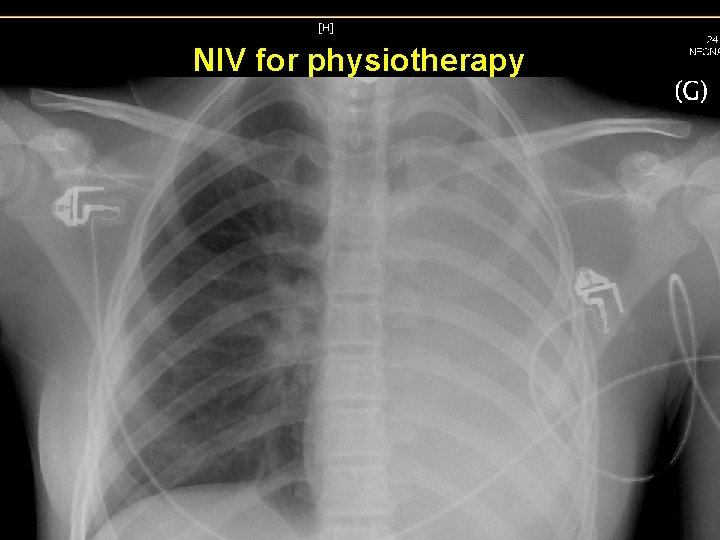 NIV for physiotherapy NIV for physiotherapy