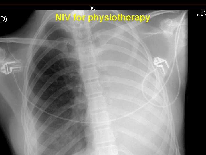 NIV for physiotherapy 
