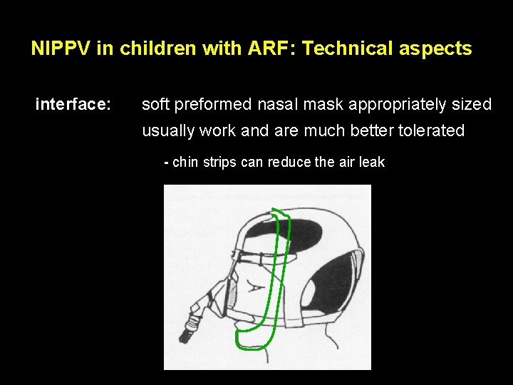 NIPPV in children with ARF: Technical aspects interface: soft preformed nasal mask appropriately sized