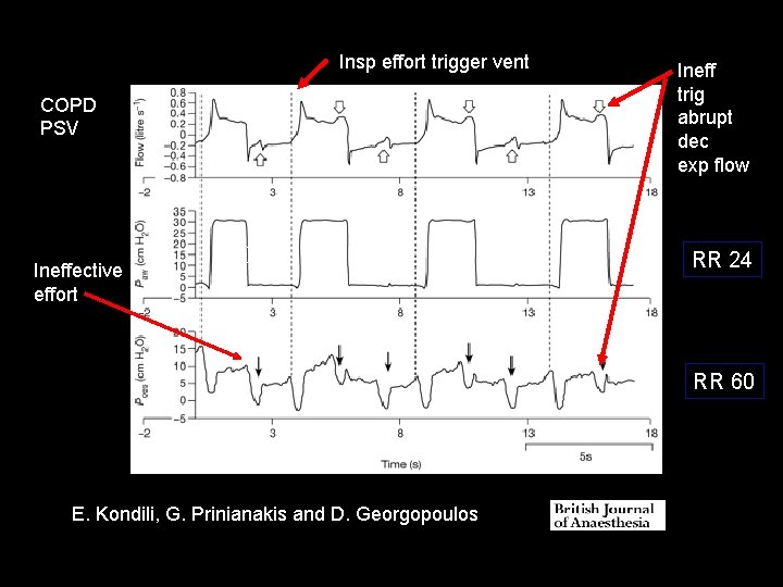 Insp effort trigger vent COPD PSV Ineffective effort (12) Ineff trig abrupt dec exp Insp effort trigger vent COPD PSV Ineffective effort (12) Ineff trig abrupt dec exp