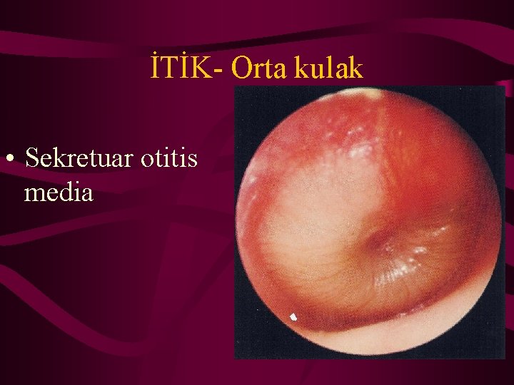 İTİK- Orta kulak • Sekretuar otitis media 