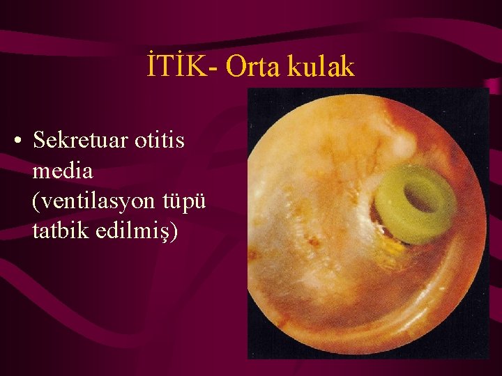 İTİK- Orta kulak • Sekretuar otitis media (ventilasyon tüpü tatbik edilmiş) 