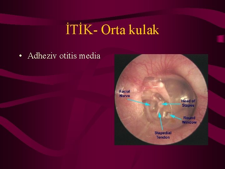 İTİK- Orta kulak • Adheziv otitis media 