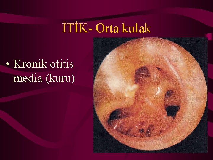 İTİK- Orta kulak • Kronik otitis media (kuru) 