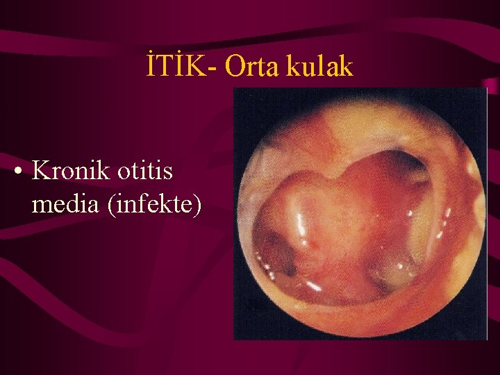 İTİK- Orta kulak • Kronik otitis media (infekte) 