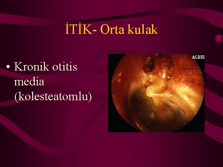 İTİK- Orta kulak • Kronik otitis media (kolesteatomlu) 