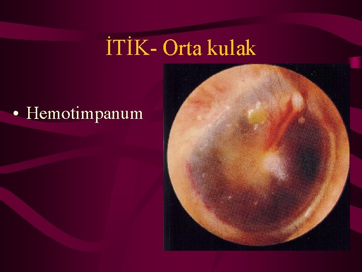 İTİK- Orta kulak • Hemotimpanum 