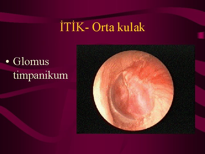 İTİK- Orta kulak • Glomus timpanikum 