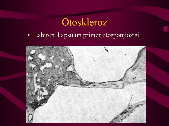 Otoskleroz • Labirent kapsülün primer otosponjiozisi 