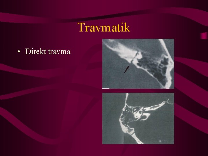 Travmatik • Direkt travma 