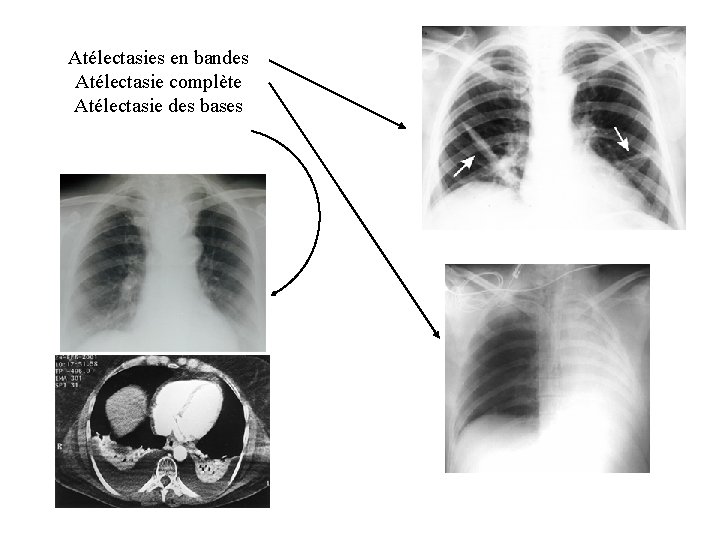 Atélectasies en bandes Atélectasie complète Atélectasie des bases 