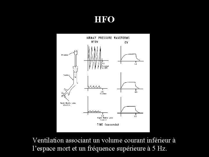 HFO Ventilation associant un volume courant inférieur à l’espace mort et un fréquence supérieure