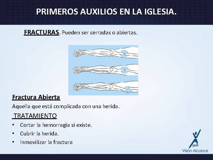 PRIMEROS AUXILIOS EN LA IGLESIA. FRACTURAS. Pueden ser cerradas o abiertas. Fractura Abierta Aquella