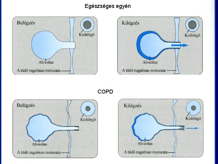 Egészséges egyén COPD 