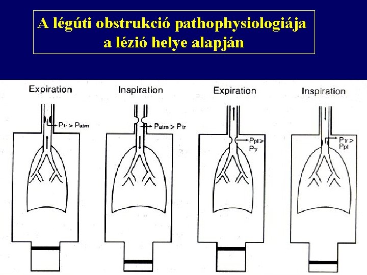 A légúti obstrukció pathophysiologiája a lézió helye alapján 