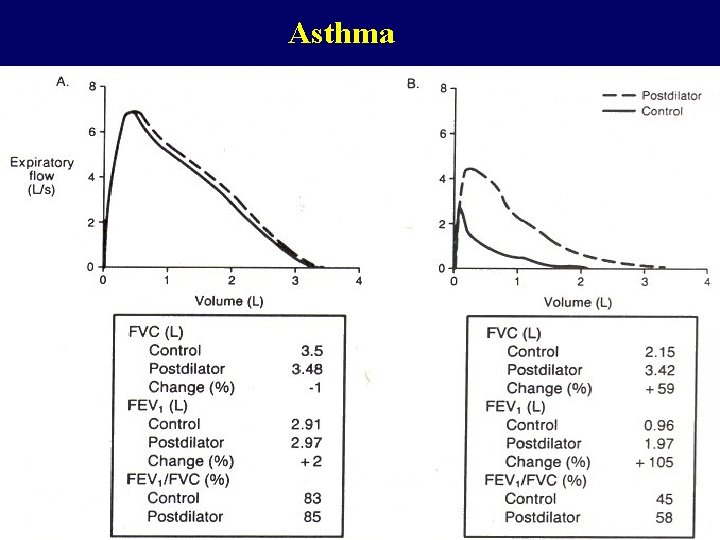 Asthma 