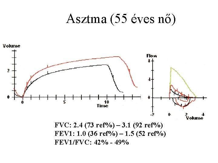 Asztma (55 éves nő) FVC: 2. 4 (73 ref%) – 3. 1 (92 ref%)