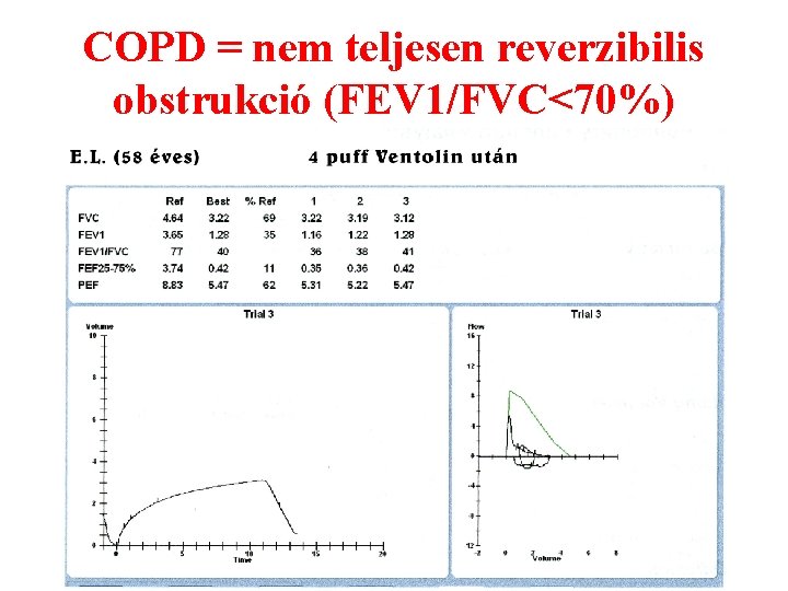 COPD = nem teljesen reverzibilis obstrukció (FEV 1/FVC<70%) 