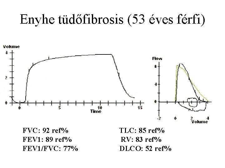 Enyhe tüdőfibrosis (53 éves férfi) FVC: 92 ref% FEV 1: 89 ref% FEV 1/FVC: