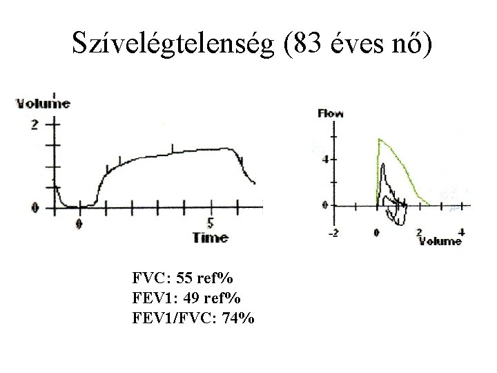 Szívelégtelenség (83 éves nő) FVC: 55 ref% FEV 1: 49 ref% FEV 1/FVC: 74%