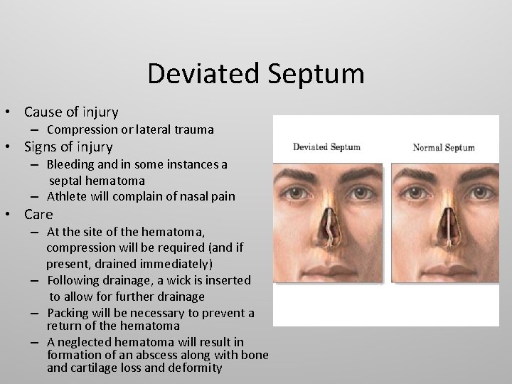 Deviated Septum • Cause of injury – Compression or lateral trauma • Signs of