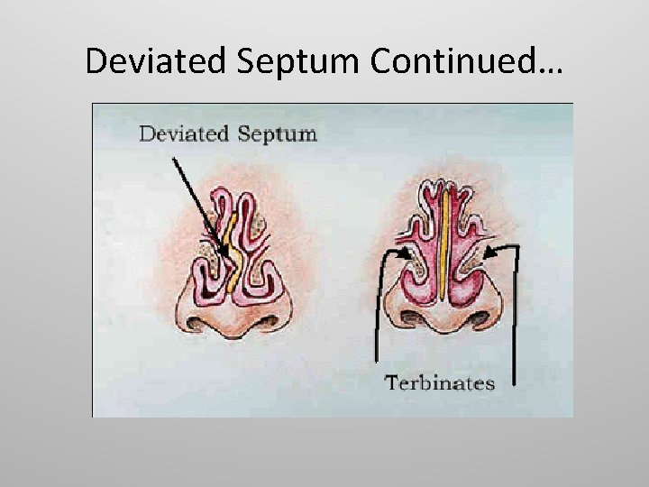 Deviated Septum Continued… 