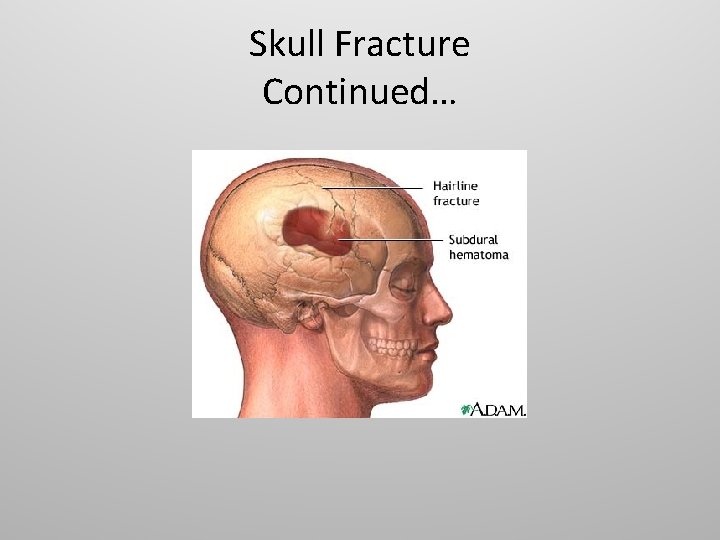 Skull Fracture Continued… 