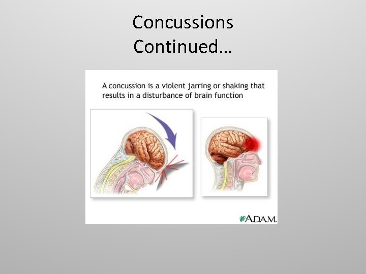 Concussions Continued… 