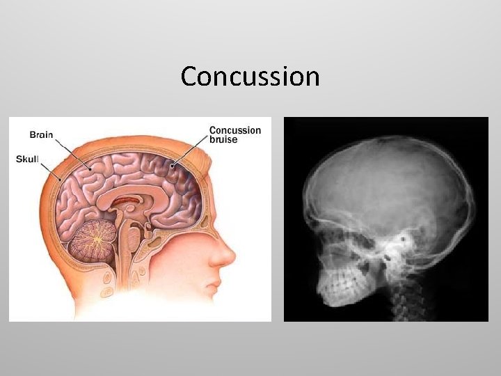 Concussion 