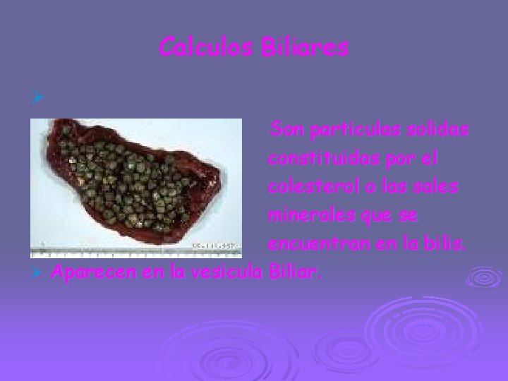 Calculos Biliares Ø Son particulas solidas Ø constituidas por el Ø colesterol o las