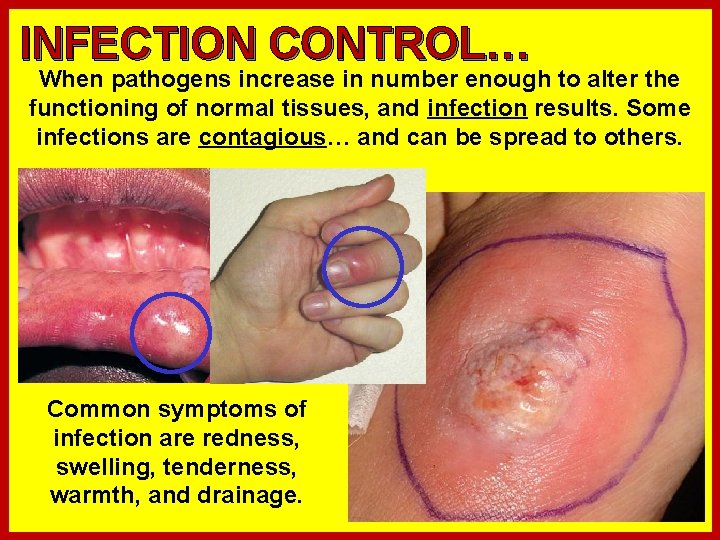 INFECTION CONTROL… When pathogens increase in number enough to alter the functioning of normal