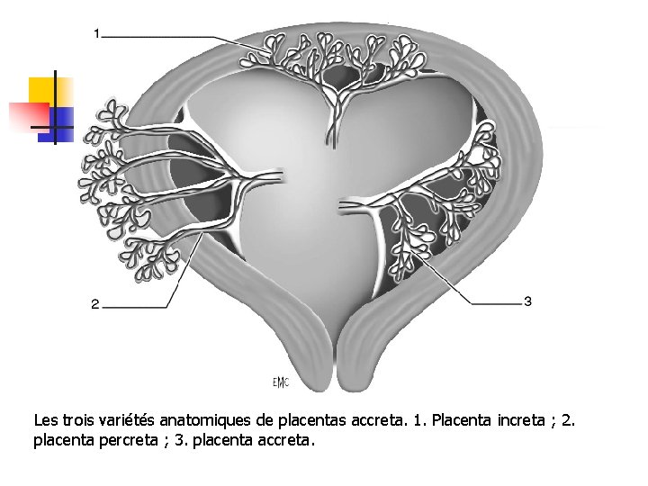 Les trois variétés anatomiques de placentas accreta. 1. Placenta increta ; 2. placenta percreta