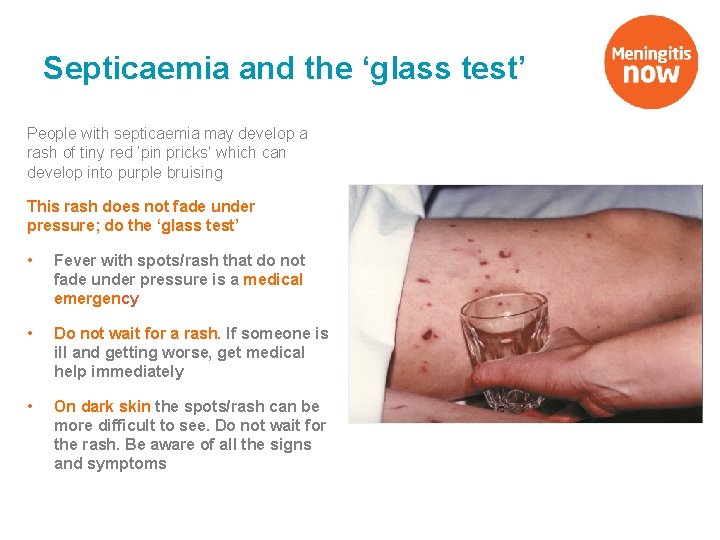 Septicaemia and the ‘glass test’ People with septicaemia may develop a rash of tiny