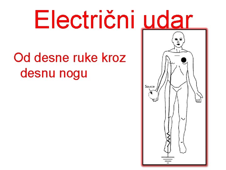 Electrični udar Od desne ruke kroz desnu nogu 