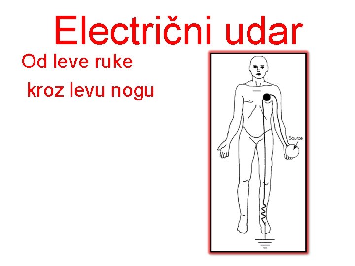 Electrični udar Od leve ruke kroz levu nogu 