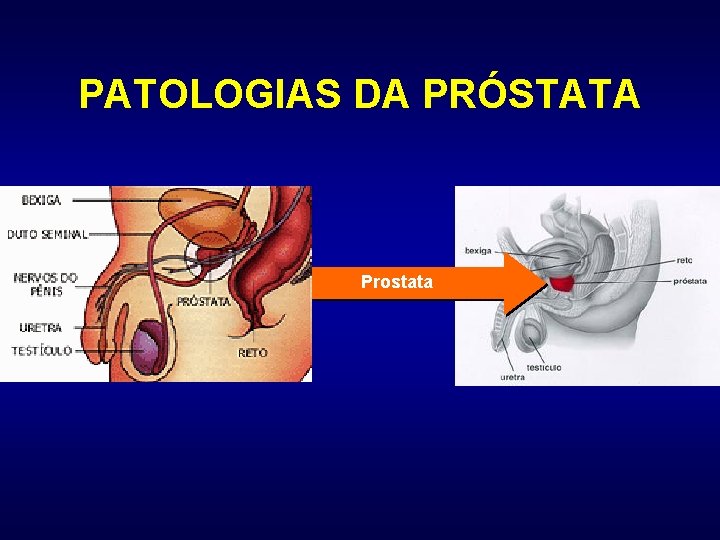 Cum acționează prostatita purulentă asupra spermei