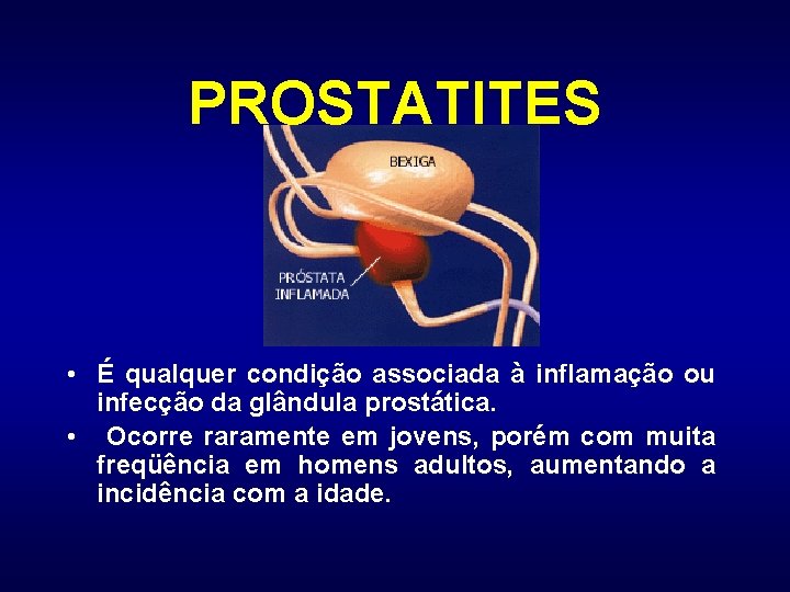 Prostatita poate fi provocată de boli cu transmitere sexuală
