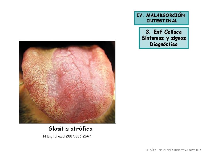 IV. MALABSORCIÓN INTESTINAL 3. Enf. Celíaca Síntomas y signos Diagnóstico Glositis atrófica N Engl