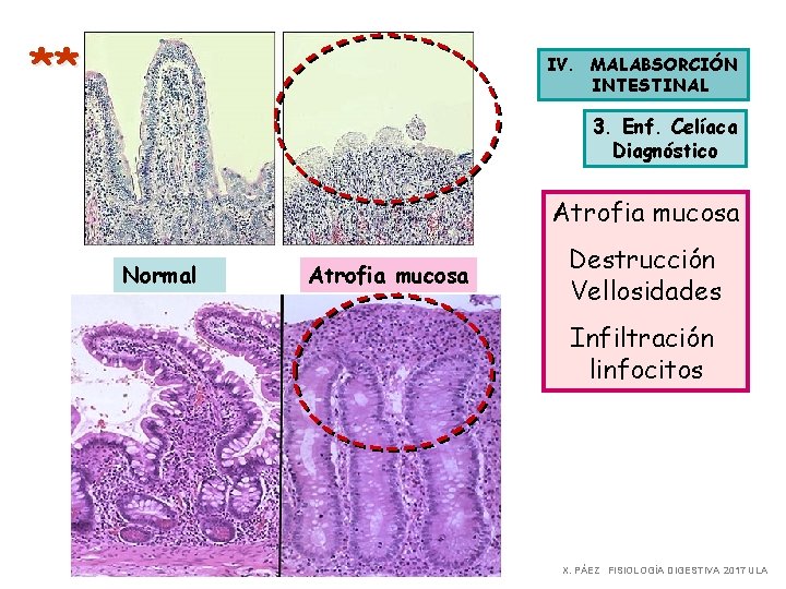** IV. MALABSORCIÓN INTESTINAL 3. Enf. Celíaca Diagnóstico Atrofia mucosa Normal Atrofia mucosa Destrucción