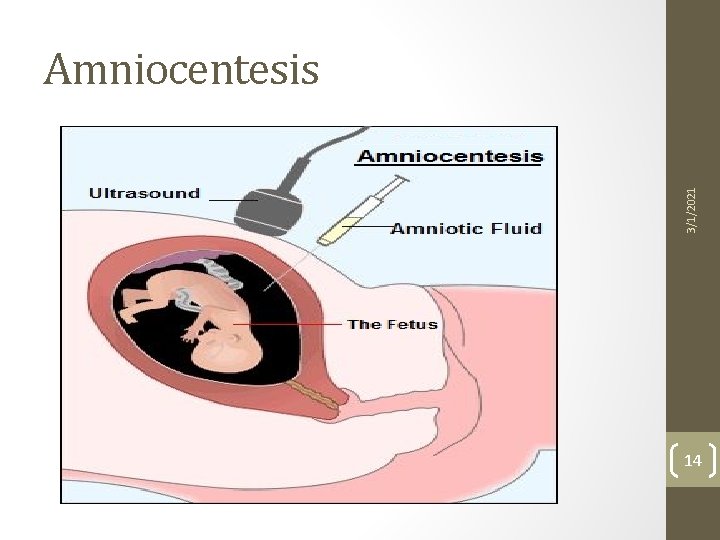 3/1/2021 Amniocentesis 14 